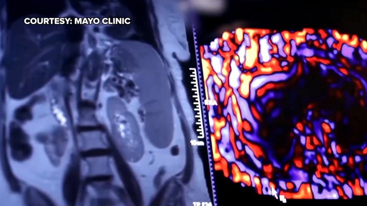 Healthy SA: Battling liver cancer, a disease which often has no symptoms early on — KENS 5 (San Antonio), Dickinson Health news